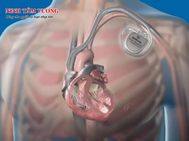 Trong trường hợp nặng, người có hội chứng tái cực sớm cần đặt máy khử rung tim.webp